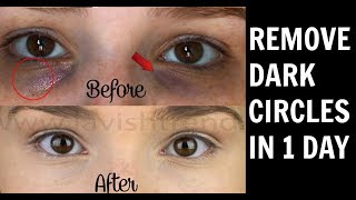 Remove Dark Circles in 1 Day -  3 Remedies to Get Rid of Puffy Eyes, Swollen Eyelids & Dark Circles