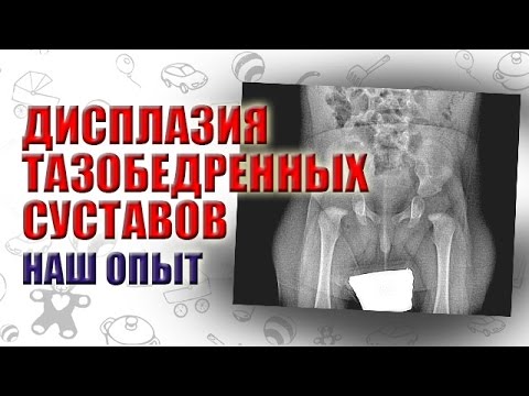 ДИСПЛАЗИЯ ТАЗОБЕДРЕННЫХ СУСТАВОВ У ДЕТЕЙ. СИМПТОМЫ ДИСПЛАЗИИ. КАК МЫ УЗНАЛИ О ДИСПЛАЗИИ