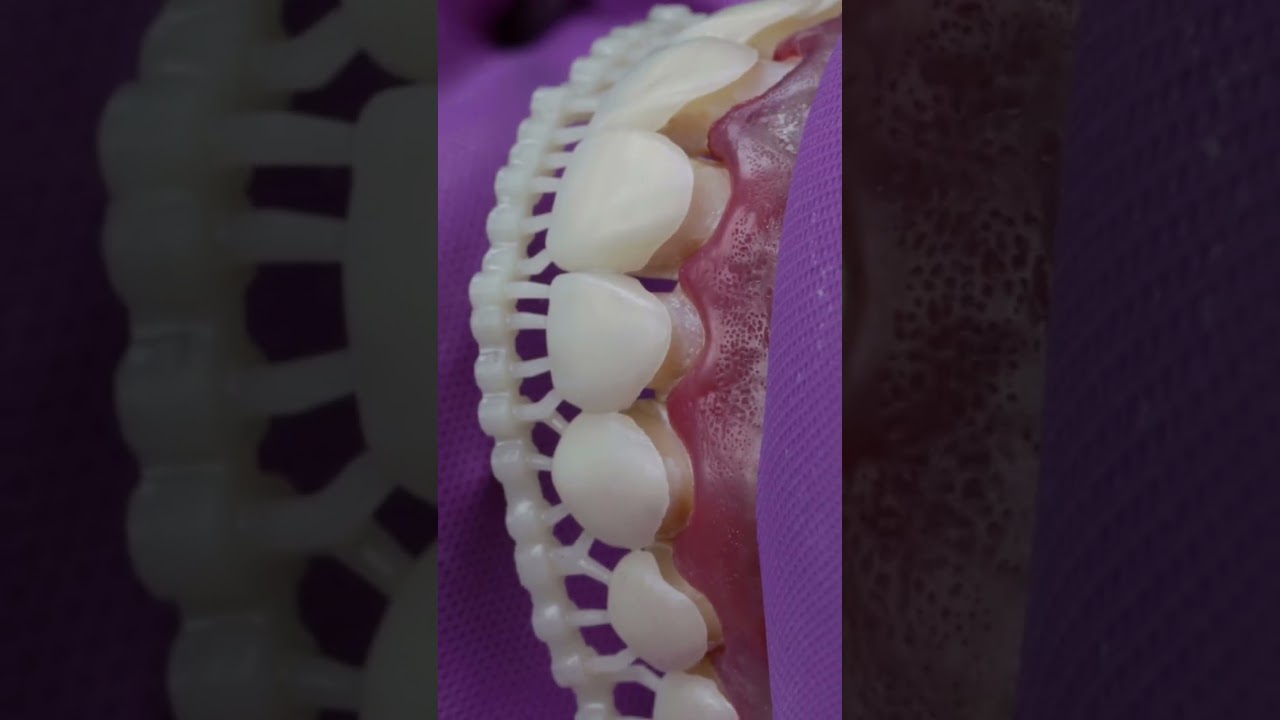 3D Printed Veneer Prototypes