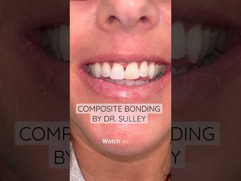 Composite bonding by Dr. Sulley 🤩 #ruhdental