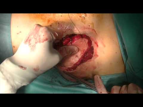 Preparazione di dolori articolari La terapia esercizio di controindicazioni osteocondrosi