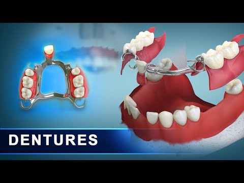 Dentures | Removal dentures - complete and partial - upper and lower jaw | 3d Dental Animation
