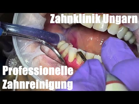 PZR in 100 Sekunden - Professionelle Zahnreinigung beugt Karies & Parodontitis vor