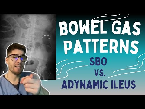 SBO vs. Adynamic Ileus! Learn the 3-6-9 rule to read bowel gas patterns on X-rays!