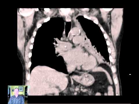 Przypadek pacjenta z pierwotnym guzem płuca - analiza RTG i TK klatki piersiowej