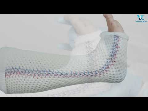 Below Elbow Cast