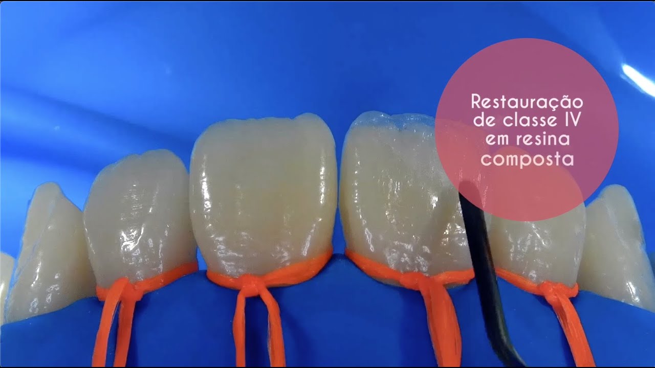Restauração de classe IV no dente 11 fraturado