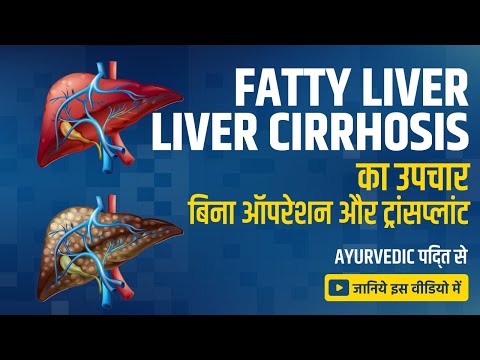 Fatty Liver, Liver Cirrhosis Or Any Liver Disease?  Get Solution Without Transplant Or Operation.