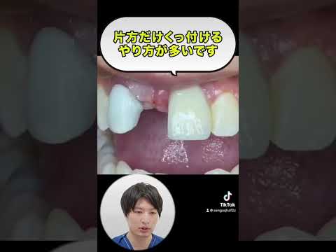 ダイレクトブリッジでの歯科治療！#shorts