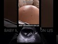 37 Weeks Baby Movement on Scans