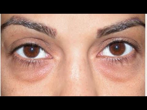 Ja ushqimet që ju bëjnë të zgjoheni me sy të fryrë