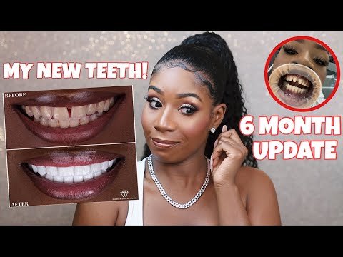 DO I REGRET GETTING VENEERS IN TURKEY?! *THE TRUTH* | 6 Month Update Q&A