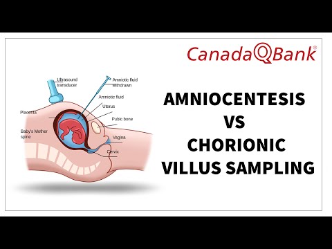 Chorionic Villus Sampling Cvs