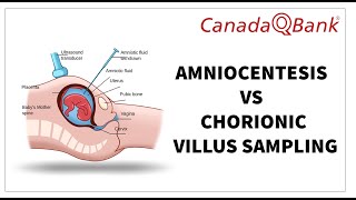 Amniocentesis vs Chorionic Villus Sampling: Key Differences, Indications & Risks | OB/GYN High-Yield