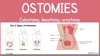 Ostomies Explained: Colostomy, Ileostomy, Urostomy | Types and care interventions