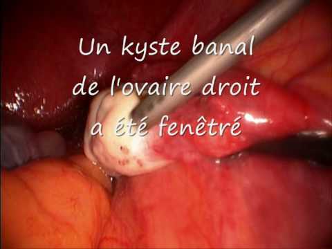 comment traiter un kyste à l'ovaire