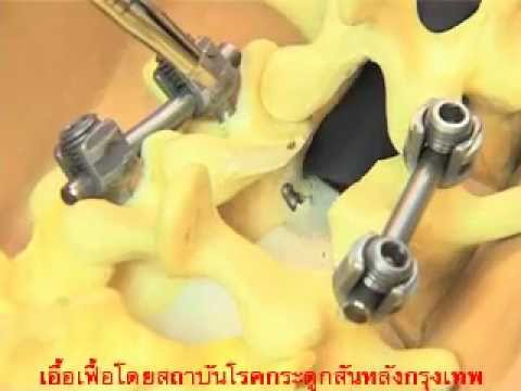 หน้าอกเล็กที่ไม่มีสายหนัง ดูเหมือนว่าเต้านม implants 300 มล.
