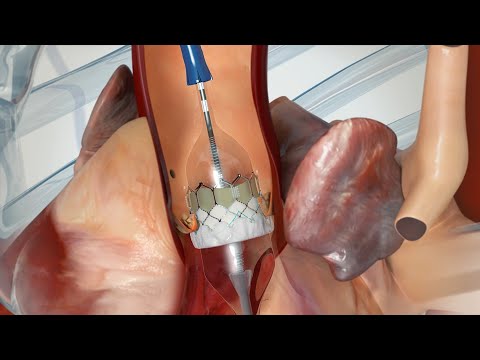 What to Expect: Transcatheter Aortic Valve Replacement (TAVR)