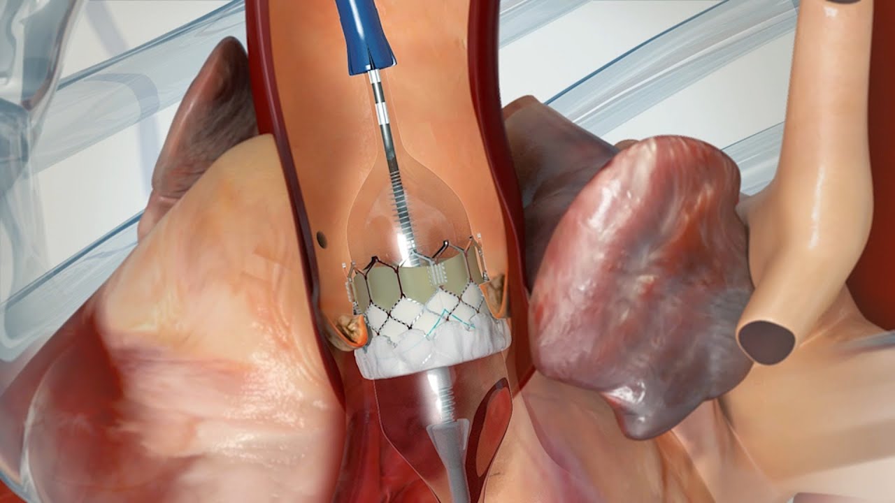 What to Expect: Transcatheter Aortic Valve Replacement (TAVR)