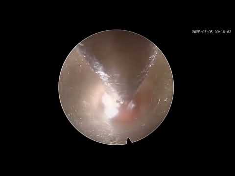 Surgical Video
