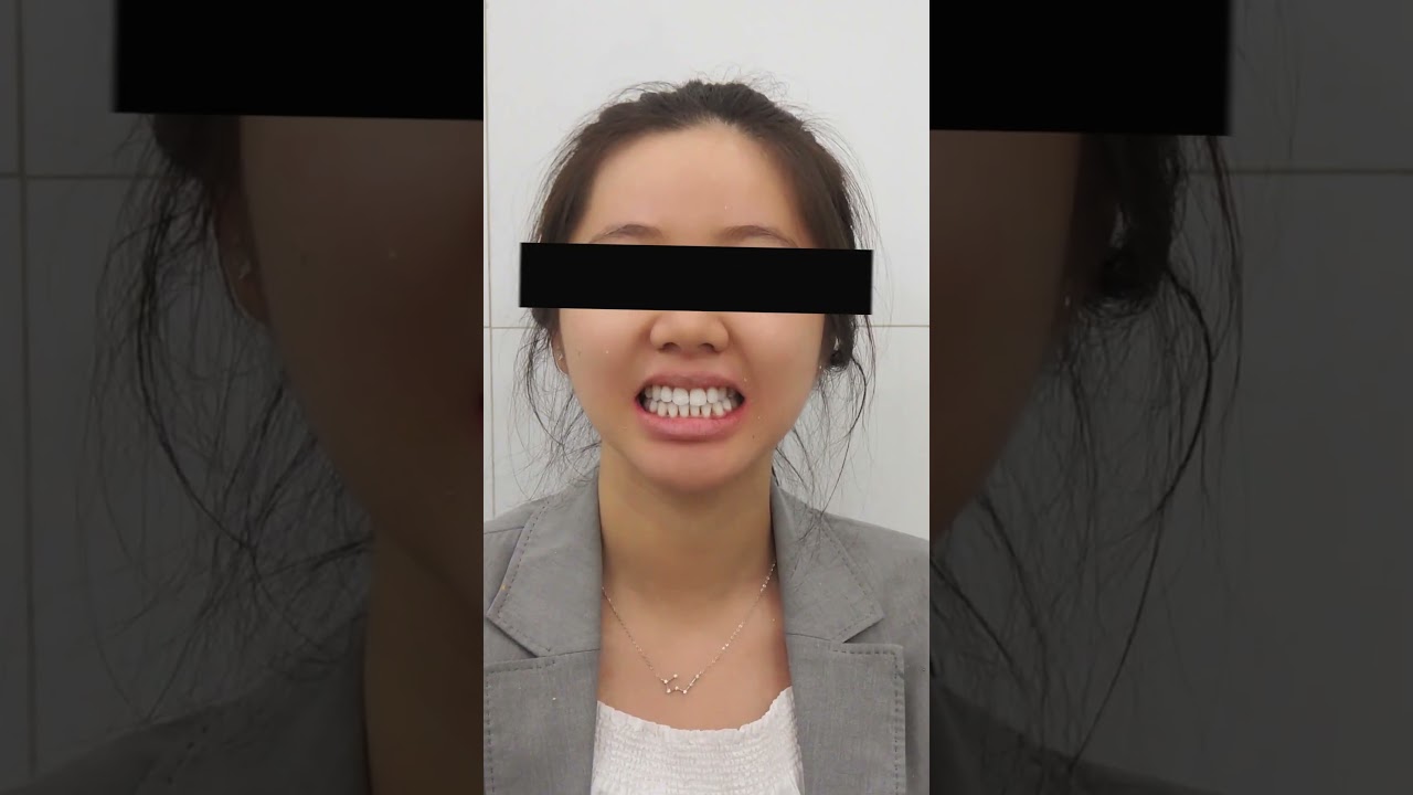 Nụ cười hạnh phúc Big Dent 2
