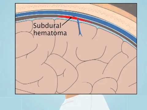 Understanding Subdural Hematoma