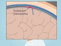 Understanding Subdural Hematoma