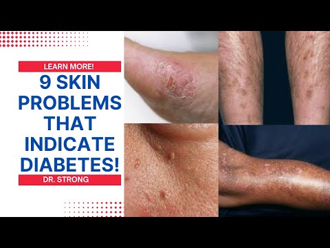 "9 Diabetic Skin Problems You Shouldn't Ignore: Signs of Diabetes You Need to Know"