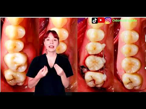 Autotrasplante Dental