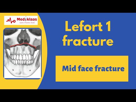 Le Fort I Fracture l Mid face fracture l Oral surgery l Mediklaas