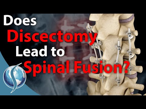 Does Discectomy Lead to Spinal Fusion?