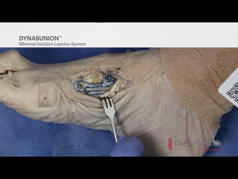 DYNABUNION™ 4D Minimal-Incision Lapidus System - Cadaveric Surgical Demo