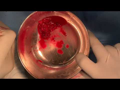 Iliac Crest Cancellous Atraumatic Bone Harvesting For Alveolar Grafting