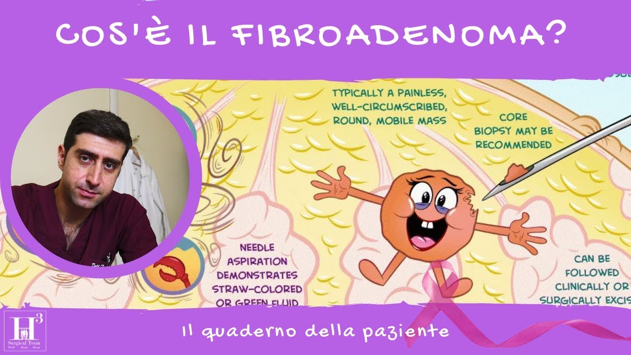 COS'È IL FIBROADENOMA (o FAD o fibradenoma) 👨‍⚕️ Il quaderno della paziente