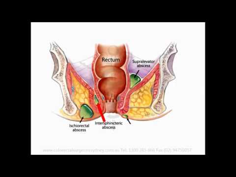 Anal Abscess - English