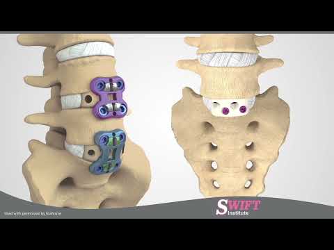 Anterior Lumbar Interbody Fusion (ALIF) in Reno, Nevada - Minimally Invasive Spine Surgery