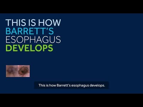 What is Barrett’s Esophagus?