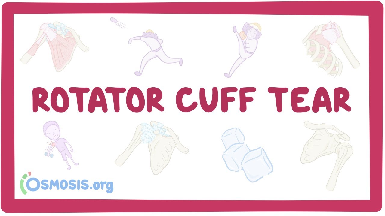 Rotator cuff tear