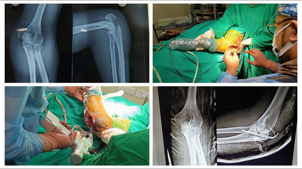 Olecranon Fracture Surgery