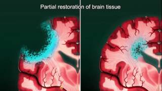 Download lagu GLSE Talks: Investigating Novel Stem Cell Treatments for Cerebral Palsy (CP) mp3 Download lagu GLSE Talks: Investigating Novel Stem Cell Treatments for Cerebral Palsy (CP) mp3