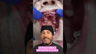 ¡Se ACABO estar SIN DIENTES! Te  enseño a RECUPERAR la SONRISA en sólo 1 Día con la CARGA INMEDIATA