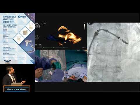 K. Papadopoulos | Live in a box Mitraclip | Mitral Session I – Complexities of Mitral Interventions
