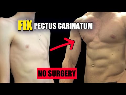 Improve Pectus Carinatum (Pigeon Chest) with Exercise