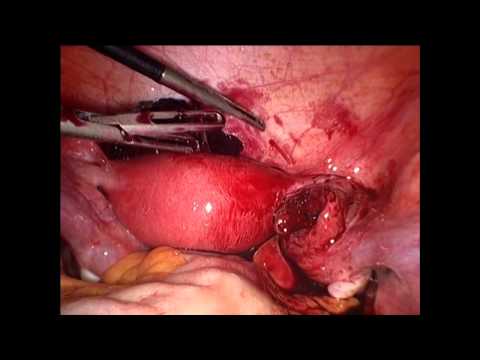 comment soigner une grossesse extra uterine