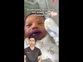Why Babies Get Oral Thrush