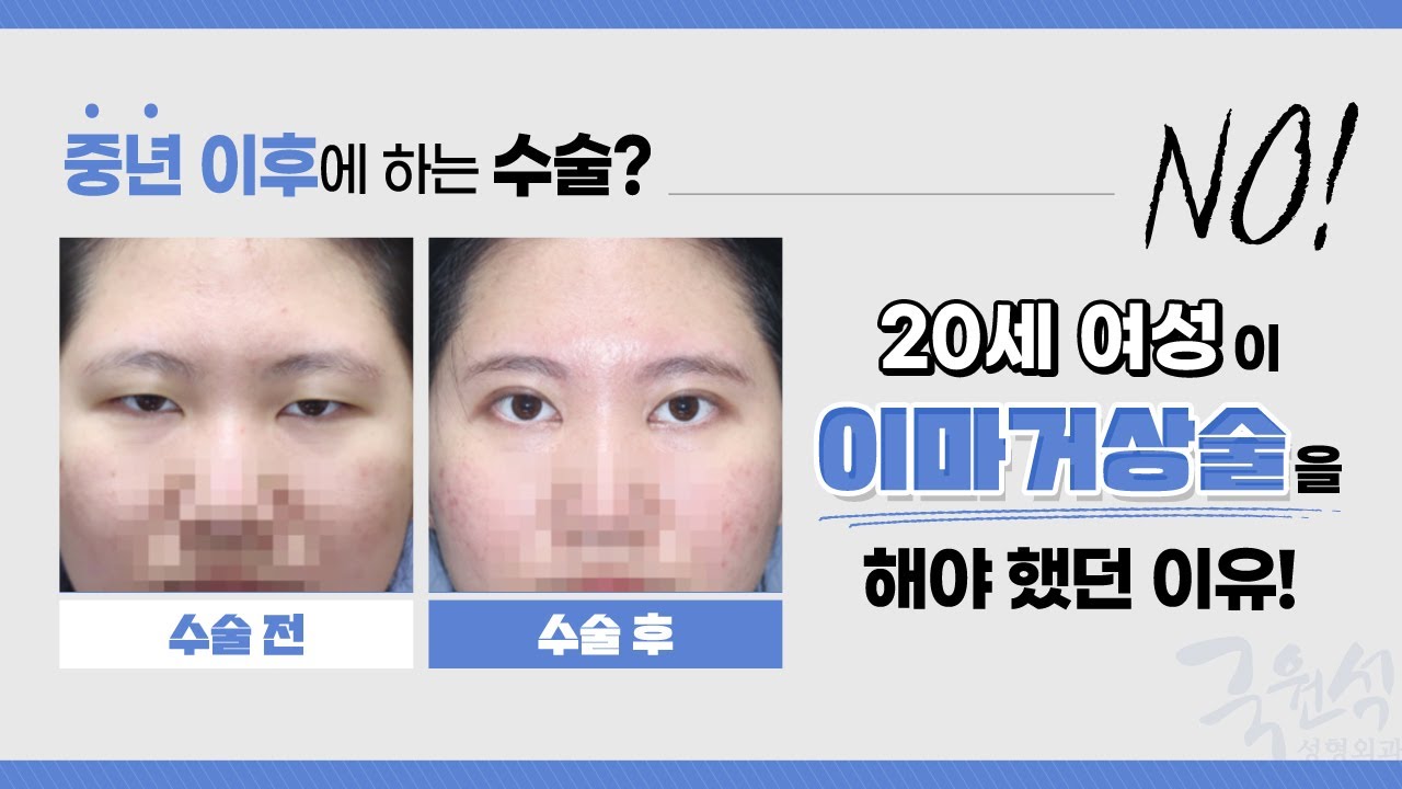 #이마거상술 20세 젊은 여성이 하게 된 이유! - 추천 영상