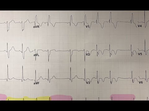 EKG: sinus arrhythmia