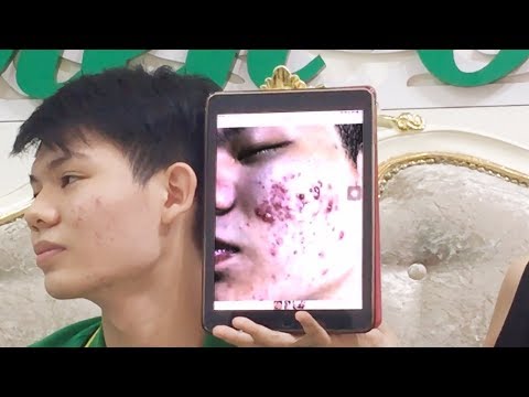 REVIEW KHÁCH HÀNG ( Mr. Nguyễn Hùng )  SAU LIỆU TRÌNH ĐIỀU TRỊ MỤN. TẠI HIỀN VÂN SPA