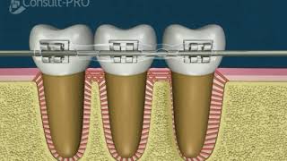 Bringing Together Tooth Movement | Teeth Bone Remodeling