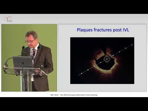 Advantages of IVL for optimal lesion preparation in calcified coronary bifurcation lesions - CASES